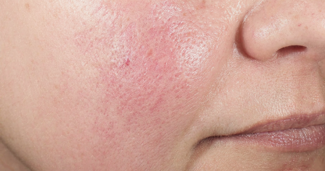That Tight Feeling After Washing Your Face? It's Not Cleanliness, It's Damage